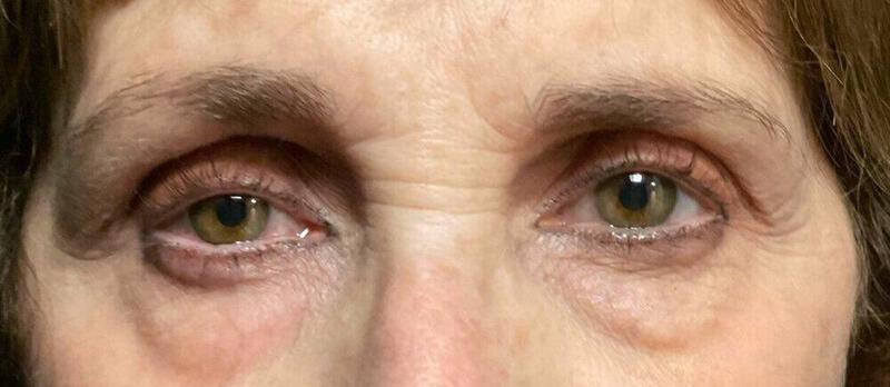 Blepharoplasty before photo
