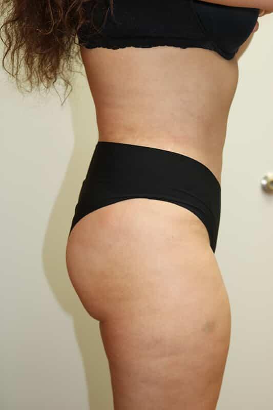 Liposuction result at ARC Plastic Surgery