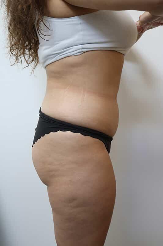Liposuction before photo