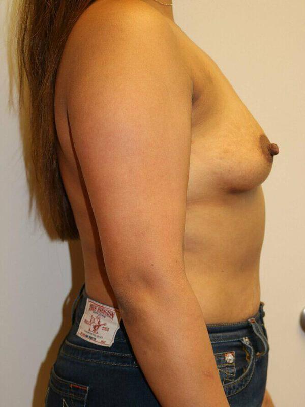 Breast Augmentation before photo