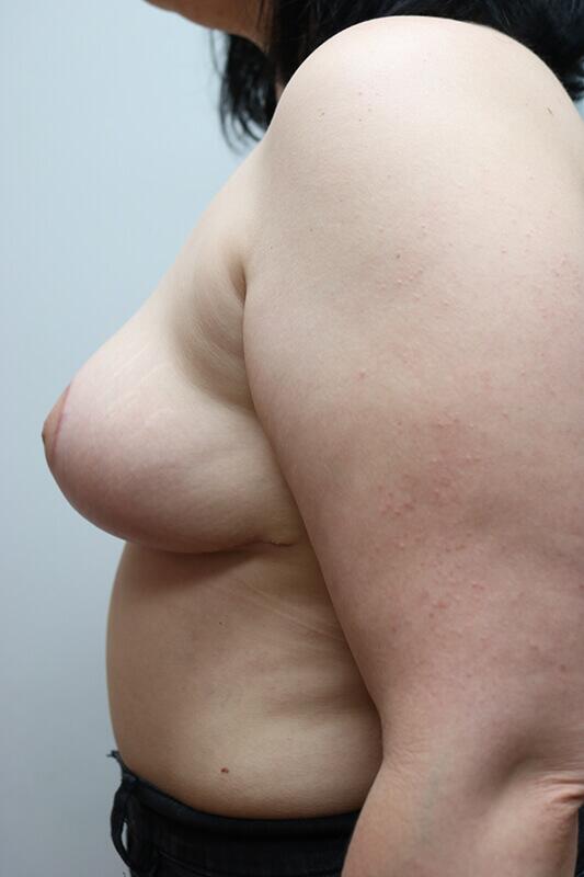 Breast Lift result at ARC Plastic Surgery