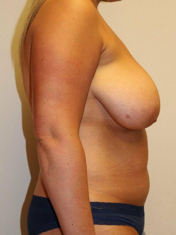 Liposuction before photo