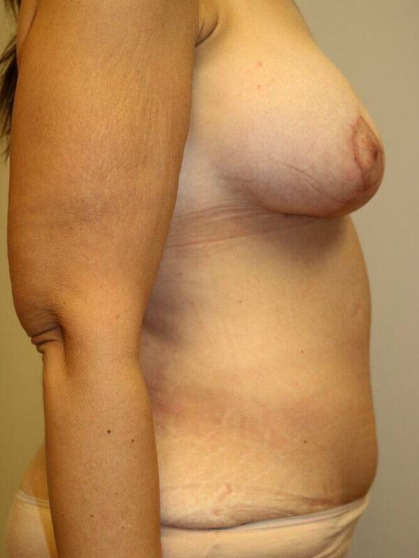 Breast Augmentation result at ARC Plastic Surgery