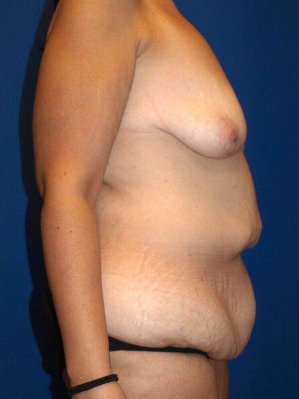 Breast Augmentation before photo