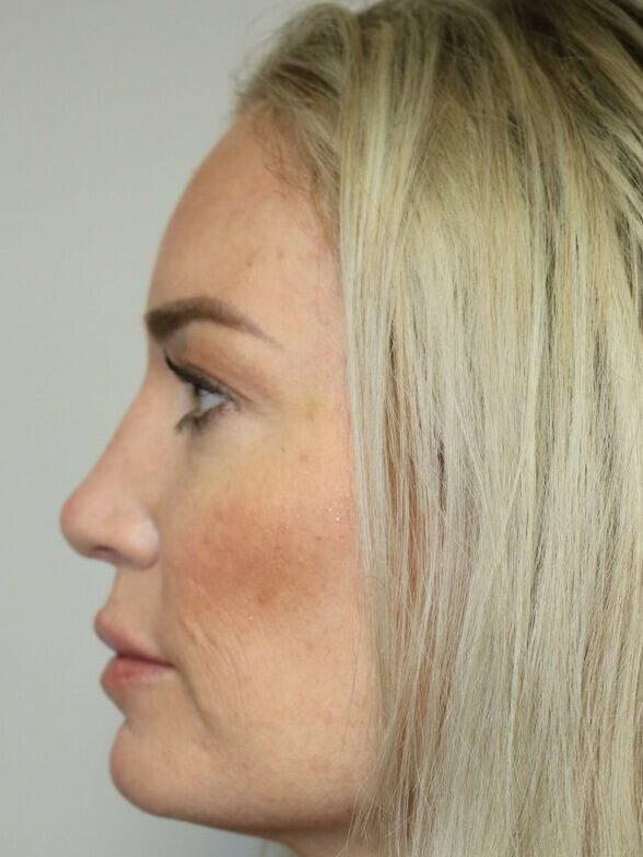 Rhinoplasty result at ARC Plastic Surgery