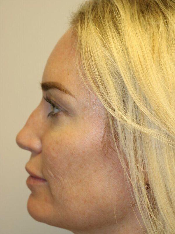 Rhinoplasty before photo