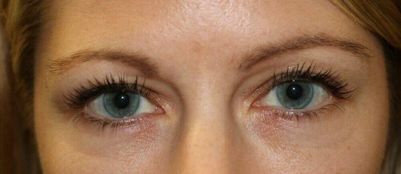 Blepharoplasty result at ARC Plastic Surgery