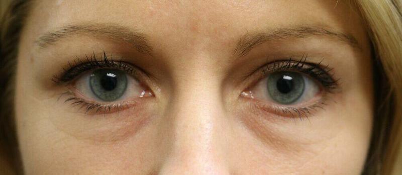 Blepharoplasty before photo