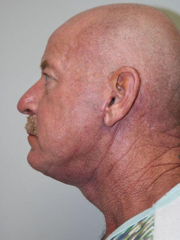 Facelift result at ARC Plastic Surgery