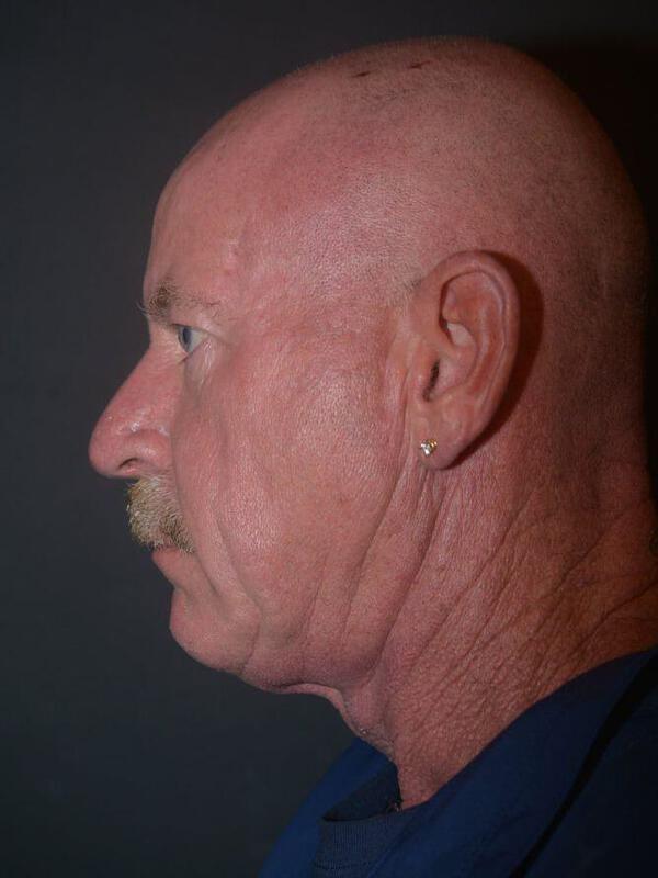 Facelift before photo