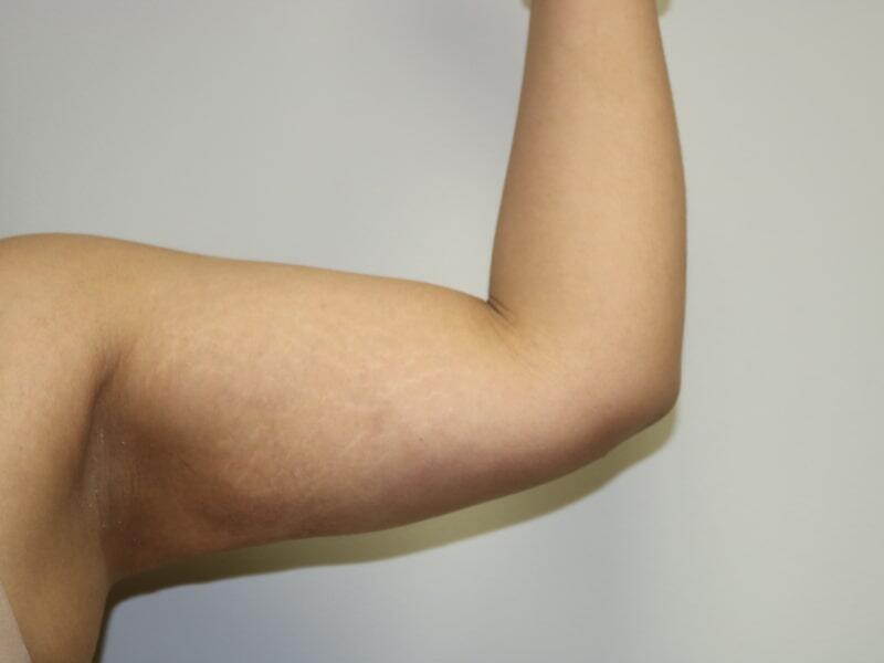 Liposuction result at ARC Plastic Surgery