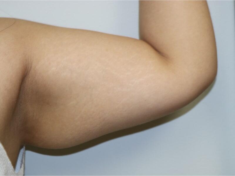 Liposuction before photo