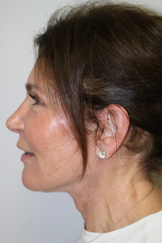 A result from ARC Plastic Surgery