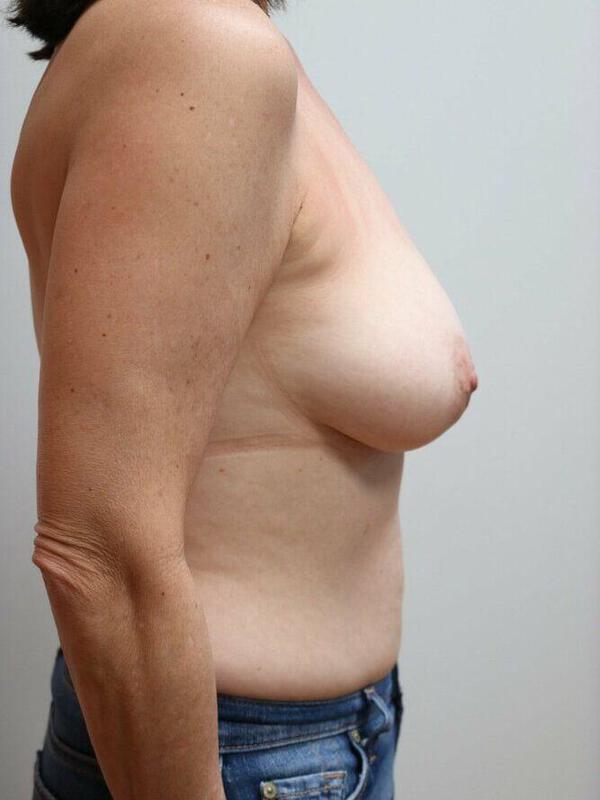 Breast Lift before photo