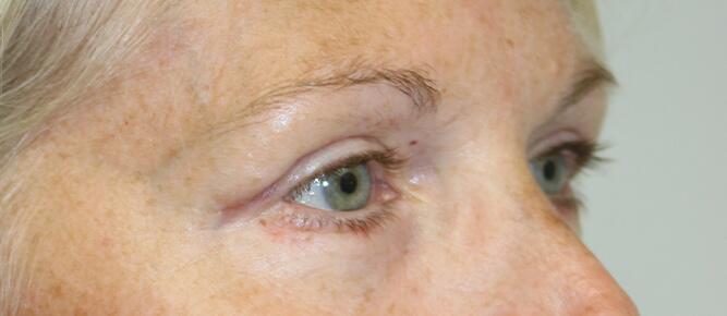 Blepharoplasty result at ARC Plastic Surgery