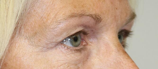 Blepharoplasty before photo