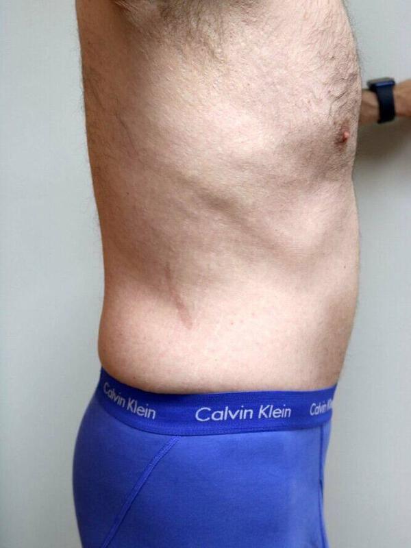 Tummy Tuck result at ARC Plastic Surgery
