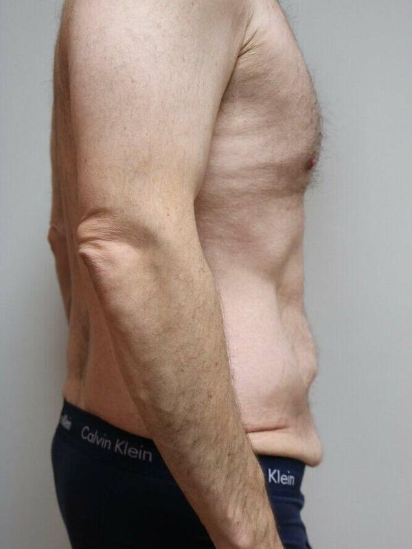 Tummy Tuck before photo