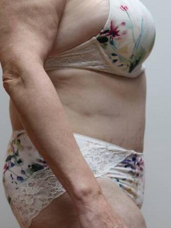Tummy Tuck result at ARC Plastic Surgery