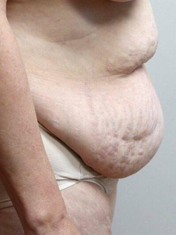 Tummy Tuck before photo