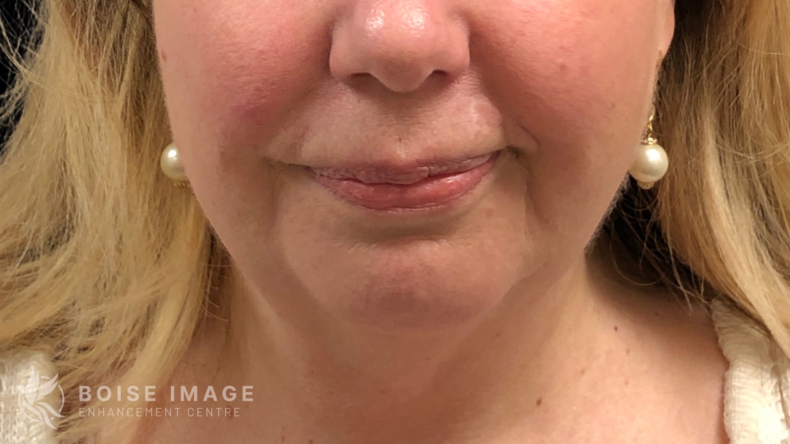 A result from Boise Image Enhancement Center, Inc