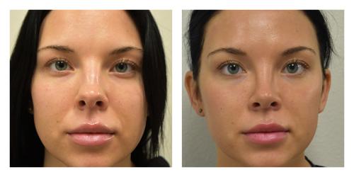 Rhinoplasty result at Smith Plastic Surgery