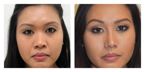 Rhinoplasty result at Smith Plastic Surgery