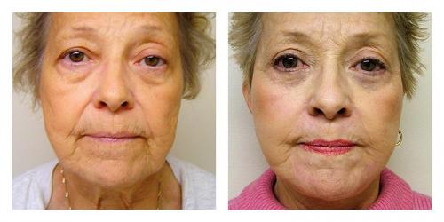 Facelift result at Smith Plastic Surgery