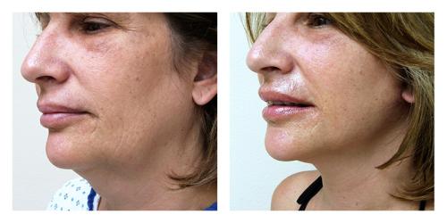 Neck Lift result at Smith Plastic Surgery