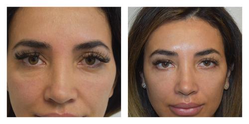 Blepharoplasty result at Smith Plastic Surgery