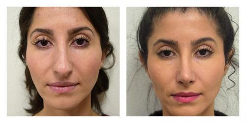 Rhinoplasty result at Smith Plastic Surgery