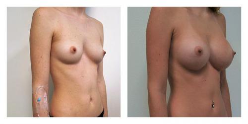 A result from Smith Plastic Surgery