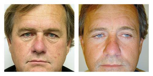 Blepharoplasty result at Smith Plastic Surgery