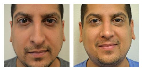Rhinoplasty result at Smith Plastic Surgery
