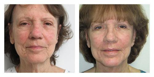 Facelift result at Smith Plastic Surgery