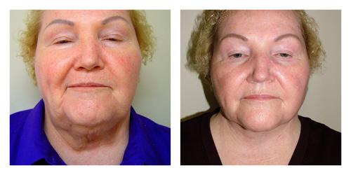 Neck Lift result at Smith Plastic Surgery