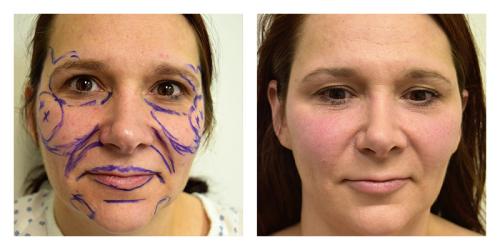 A result from Smith Plastic Surgery