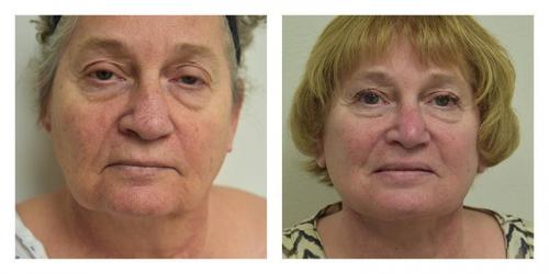 Facelift result at Smith Plastic Surgery