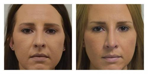 Rhinoplasty result at Smith Plastic Surgery