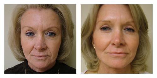 Facelift result at Smith Plastic Surgery