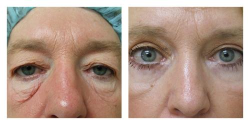 Blepharoplasty result at Smith Plastic Surgery