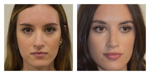 Rhinoplasty result at Smith Plastic Surgery