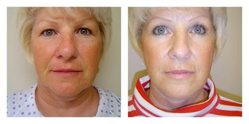 Neck Lift result at Smith Plastic Surgery