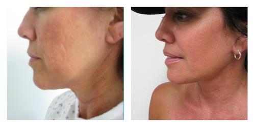 Neck Lift result at Smith Plastic Surgery