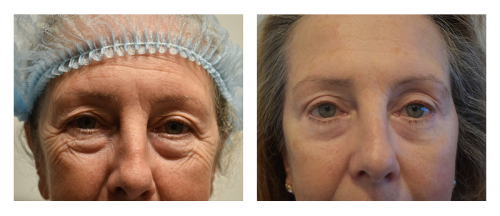 A result from Smith Plastic Surgery