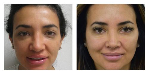 Rhinoplasty result at Smith Plastic Surgery