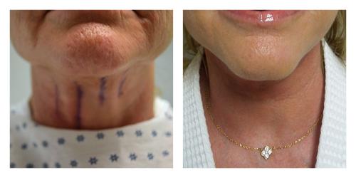 Neck Lift result at Smith Plastic Surgery