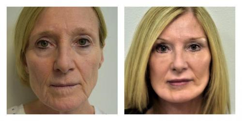 Facelift result at Smith Plastic Surgery
