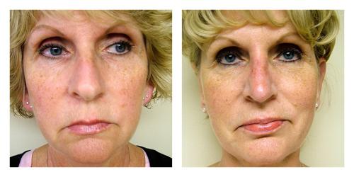 Neck Lift result at Smith Plastic Surgery