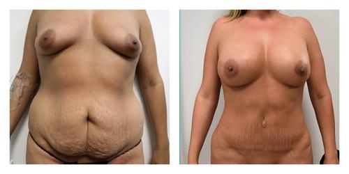 A result from Smith Plastic Surgery